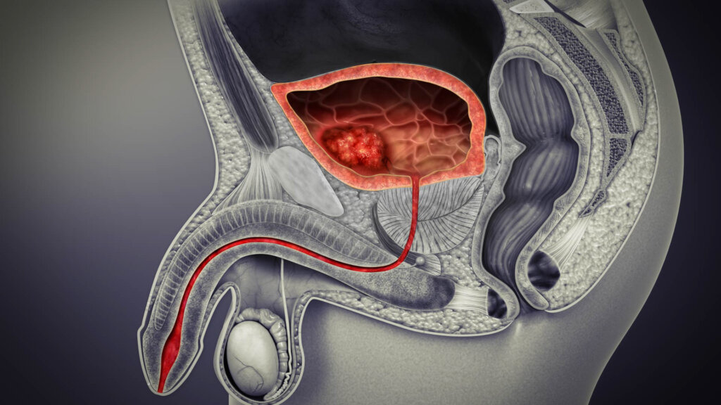 Bladder Cancer 1