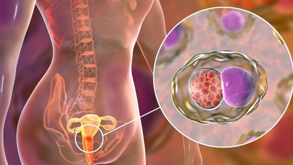 chlamydia disease 1